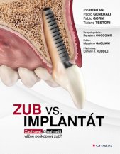 Zub vs. implantát :zachovat, či nahradit vážně poškozený zub?