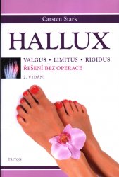 Hallux :valgus, limitus, rigidus : řešení bez operace